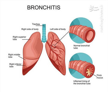 نحوه درمان و تسکین برونشیت + علائم و نشانه / عکس