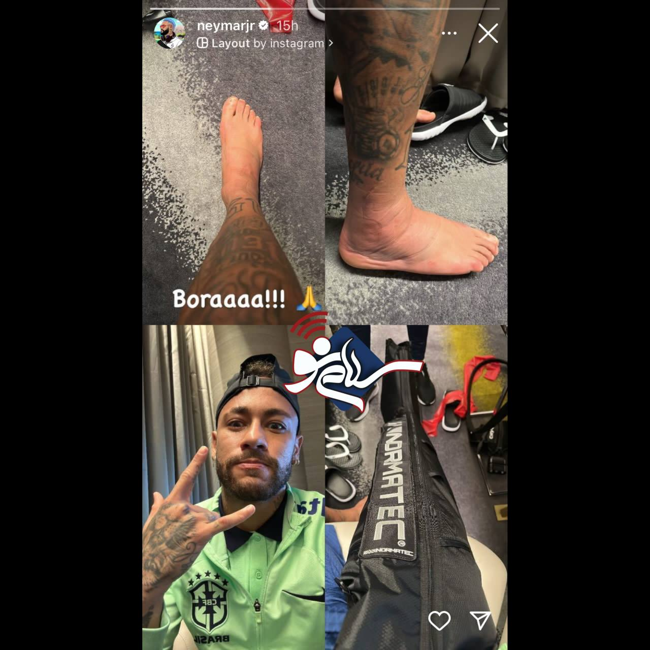 ورم عجیب پای نیمار پس از دو روز مصدومیت + عکس