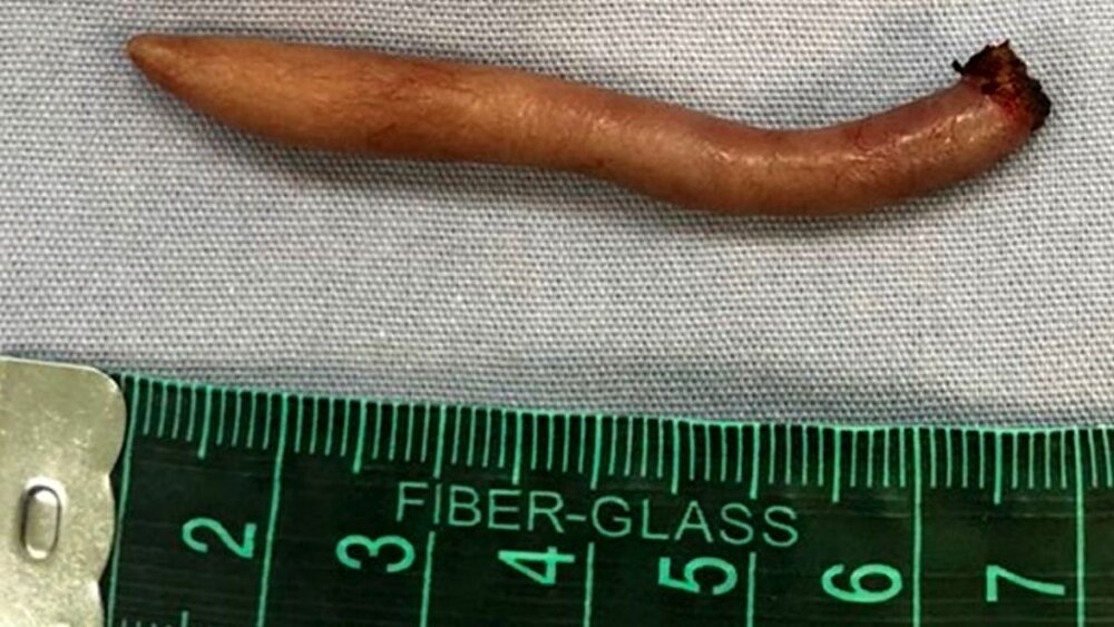 این دختربچه عجیب با ۱۲ سانت دم به دنیا آمده است! + عکس باورنکردنی