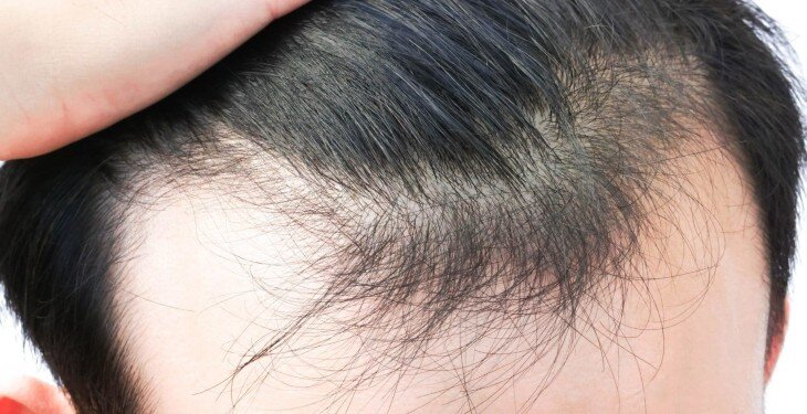 5  مورد از رایج ترین دلایل ریزش مو در خانم ها و آقایان