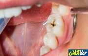 روش های جلوگیری از خرابی دندان‌