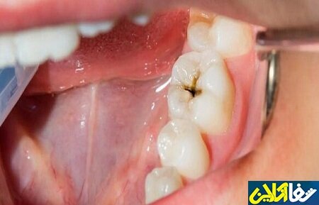 روش های جلوگیری از خرابی دندان‌