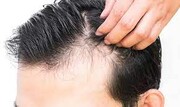 دلایل اصلی ریزش موی سر آقایان وخانم ها