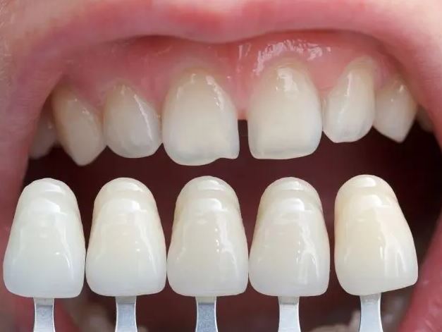 عوارض کامپوزیت دندان + قیمت کامپوزیت دندان