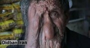 چهره وحشتناک مرد هندی به دلیل ابتلا به یک بیماری نادر + فیلم