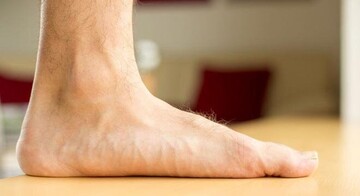 کف پای صاف چیست؟ + علل، عوارض و درمان صافی کف پا