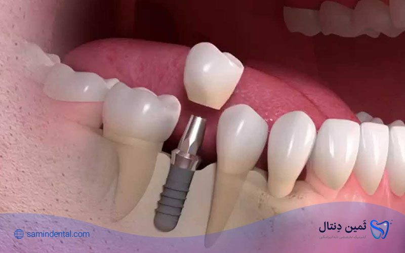 مراحل ایمپلنت دندان به چه صورت هستند؟