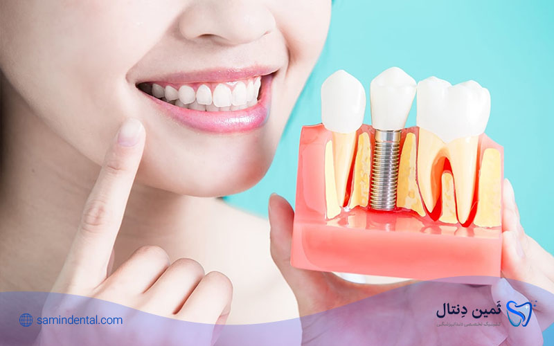 مراحل ایمپلنت دندان به چه صورت هستند؟