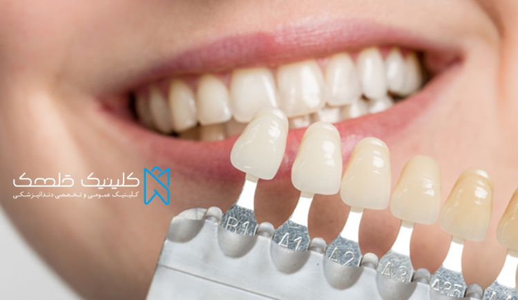 بهترین سن انجام لمینت دندان را بدانیم