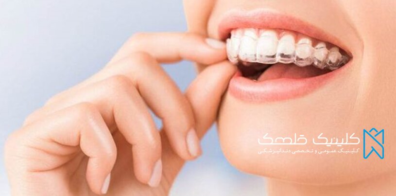 بهترین سن انجام لمینت دندان را بدانیم