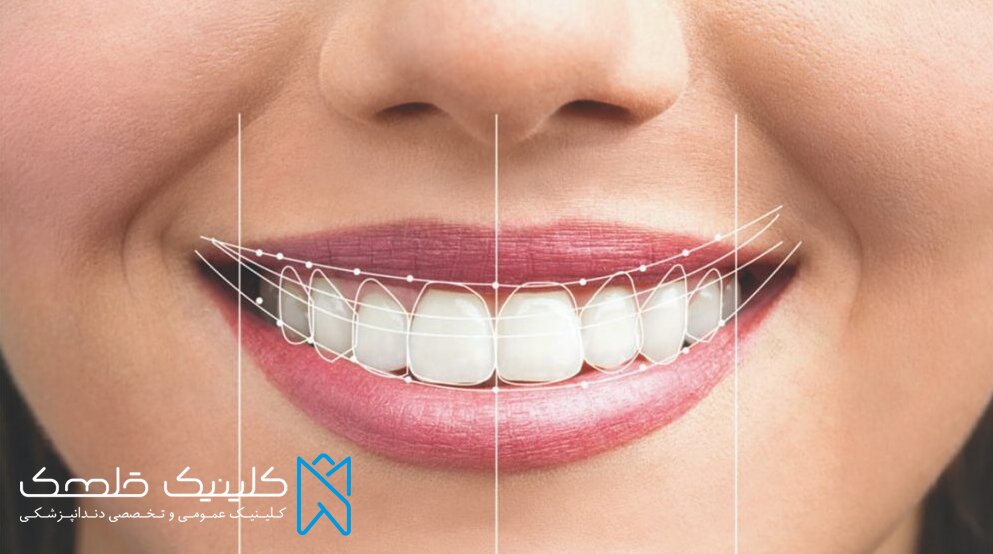 بهترین سن انجام لمینت دندان را بدانیم