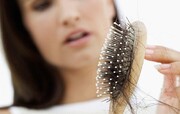 موثرترین روش های جلوگیری از ریزش مو