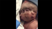تولد نوزاد عجیب الخلقه هندی با ۳ صورت و ۳ چشم! + فیلم