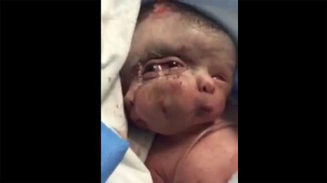 تولد نوزاد عجیب الخلقه هندی با ۳ صورت و ۳ چشم! + فیلم