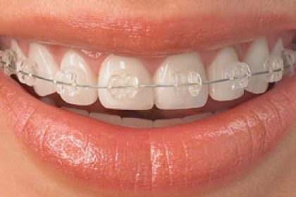 عوارض نکشیدن دندان در ارتودنسی چیست؟ 