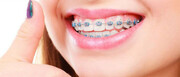 عوارض نکشیدن دندان در ارتودنسی چیست؟