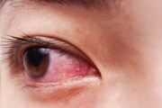 علل قرمزی چشم چیست ؟