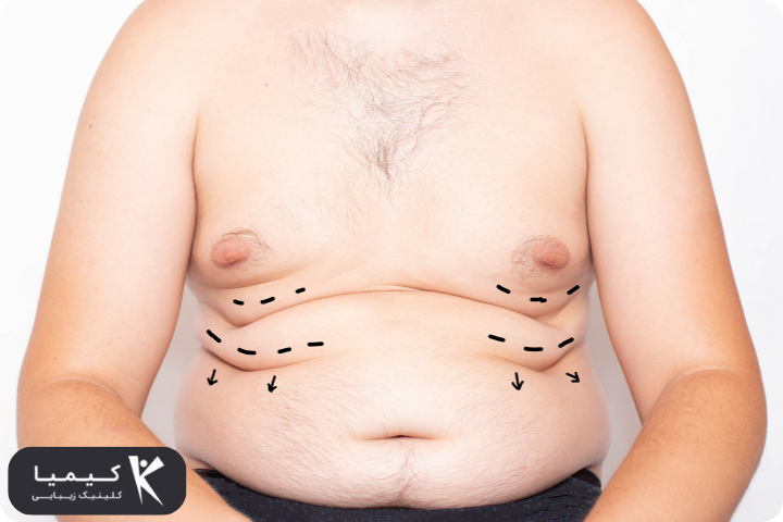 نکات مهمی که قبل از جراحی زیبایی شکم باید بدانید! به توصیه کلینیک کیمیا