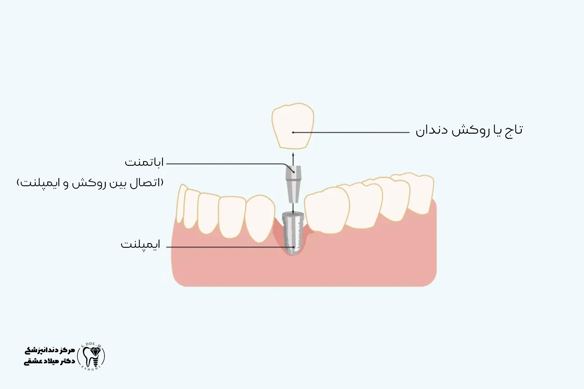 چرا دندان ایمپلنت شل یا سست میشود و چگونه میتوان آن را رفع کرد؟ 