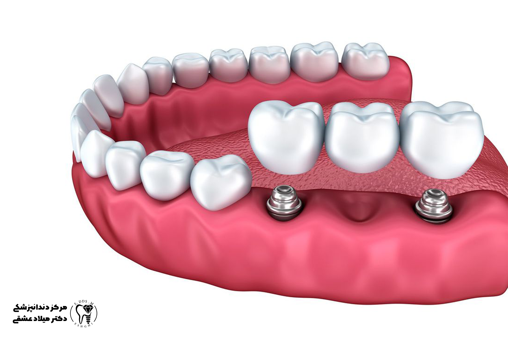 چرا دندان ایمپلنت شل یا سست میشود و چگونه میتوان آن را رفع کرد؟ 