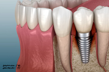 چرا دندان ایمپلنت شل یا سست میشود و چگونه میتوان آن را رفع کرد؟