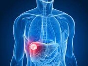 علت نارسایی کبد یا سرطان کبد چیست؟