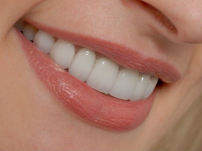 روش های سفید کردن دندان ها