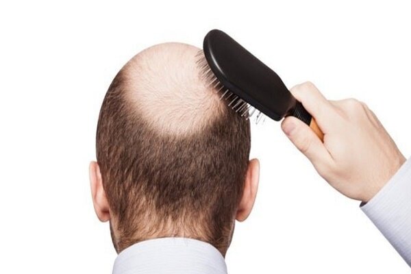 علت اصلی ریزش مو چیست؟ | چه کار کنیم دیگر موهای ما نریزد؟ 