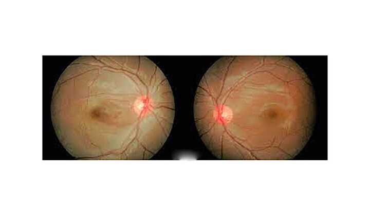 سکته چشم چیست و چه علائمی دارد؟ | نحوه پیشگیری و درمان سکته چشم چگونه است؟