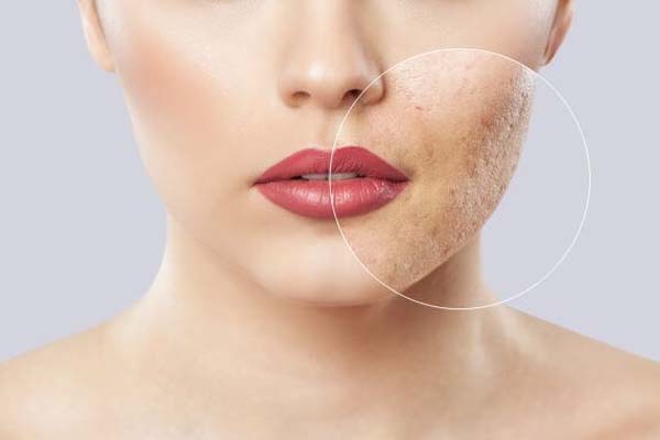 بهترین سن برای لیزر جای جوش