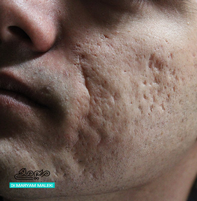 بهترین سن برای لیزر جای جوش