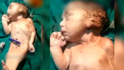 نوزاد عجیب الخلقه که شبیه پری دریایی است! + فیلم