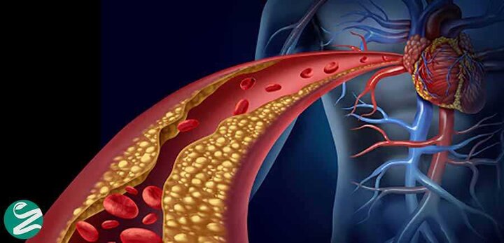 فهمیدن کلسترول خون از ظاهر بدن