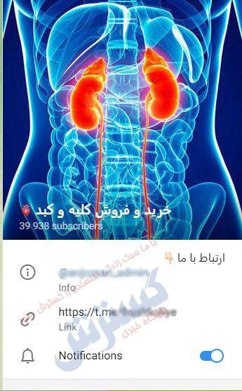 بازار سیاه فروش اعضای حیاتی بدن,درآمد دلاری خرید و فروش اعضای بدن در ایران