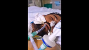 شاهکار جدید جراحان ایرانی / جراحی موفقیت‌آمیز پیوند سر قطع شده به بدن در ایران + فیلم