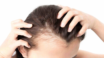 علت اصلی ریزش مو چیست؟ | چه کار کنیم ریزش موی ما قطع شود؟