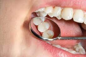 پوسیدگی دندان چه بلا سر بدن می‌آورد؟