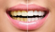 اگر این کارهارو انجام بدید دیگه دندان هایتان خراب نمی شود! + عکس