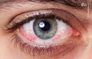 پیشگیری و درمان خشکی چشم با این ترفندهای ساده + عکس