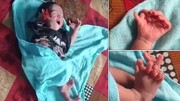 تولد نوزادی عجیب با ۱۴ انگشت دست و ۱۲ انگشت پا / عکس