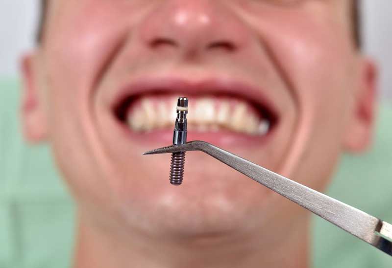قیمت ایمپلنت دندان با بیهوشی