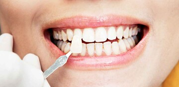 طول عمر و قیمت کامپوزیت دندان چقدر است + کامپوزیت دندان چیست