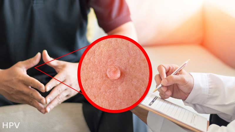 از کجا بفهمیم زگیل تناسلی داریم؟ + علایم زگیل تناسلی در مردان و زنان