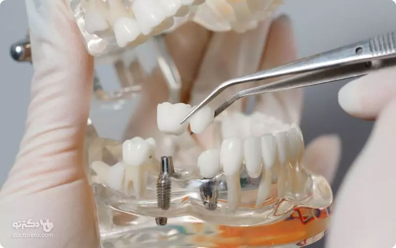 بهترین ارائه دهندگان ایمپلنت دندان با قیمت و هزینه مناسب + تخفیف در دکترتو کلینیک