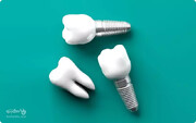 بهترین ارائه دهندگان ایمپلنت دندان با قیمت و هزینه مناسب + تخفیف در دکترتو کلینیک