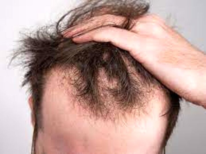  رایج‌ترین علل علمی ریزش مو را بشناسید
