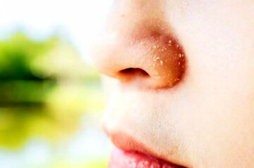 علل خشکی پوست اطراف بینی و راه درمان آن