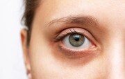 راه های درمان انواع سیاهی زیر چشم