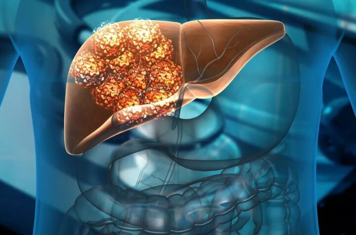 درمان سرطان کبد با میکروربات‌های هدایت‌شونده توسط میدان مغناطیسی