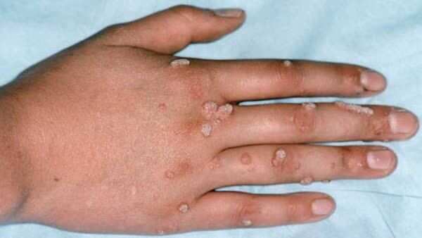 انتقال یک بیماری خطرناک در آرایشگاههای زنانه